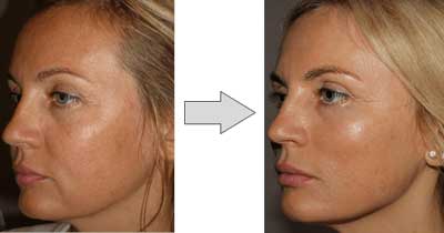 hilos tensores faciales antes y despues