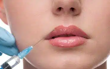 implante-acido-hialuronico-labios