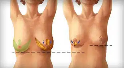 mamoplastia de reduccion
