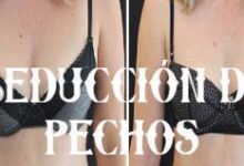 Reducción de pecho: Información sobre la mamoplastia de reducción 10 Reducción de pecho