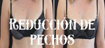 Reducción de pecho: Información sobre la mamoplastia de reducción 1 Reducción de pecho