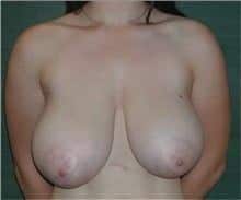 Reducción de pecho: Información sobre la mamoplastia de reducción 6 resultado reduccion de pecho