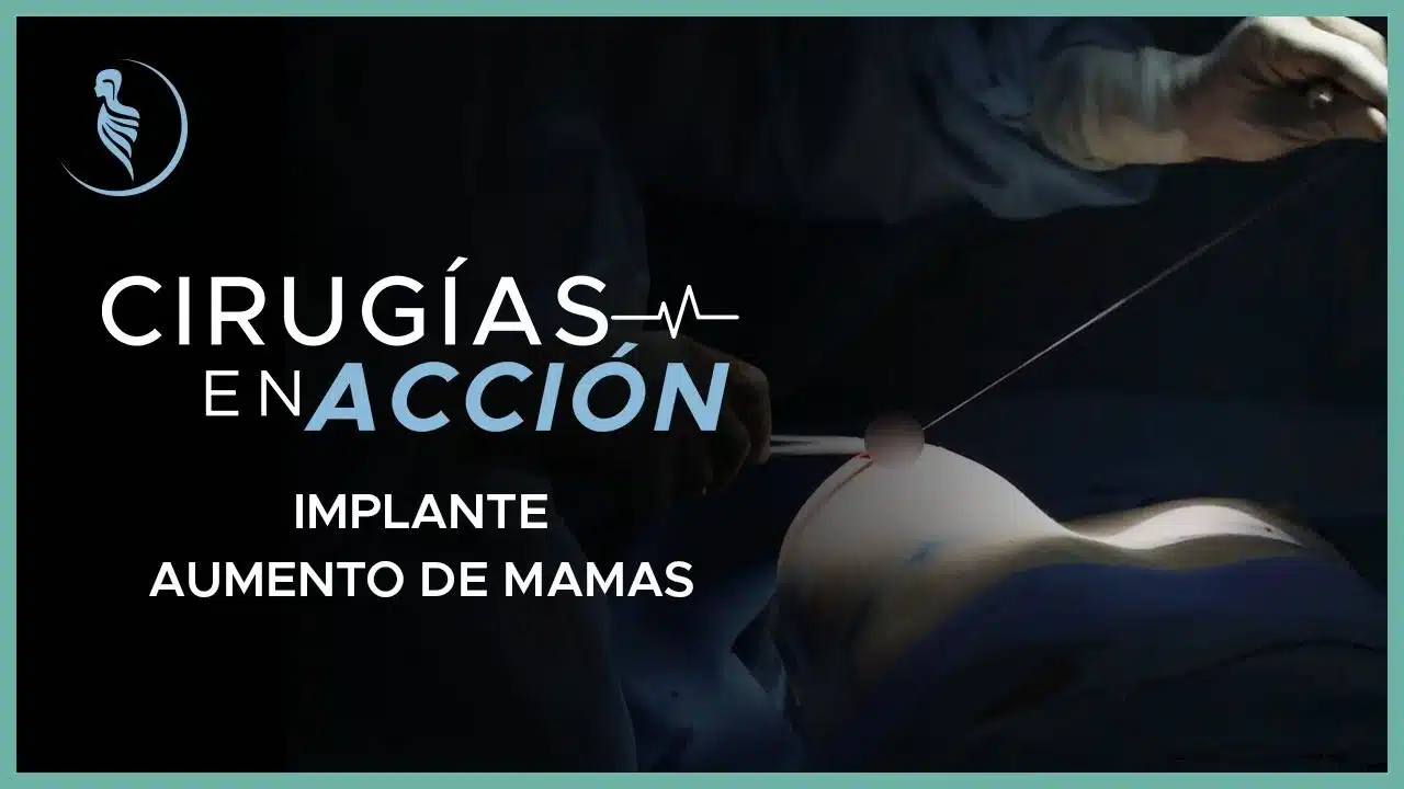 Implante/Aumento de mamas - Cirugía Plástica Martínez, Lima-Perú