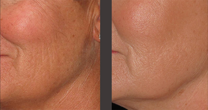 rejuvenecimiento cutáneo por radiofrecuencia y microagujas 3 resultado-genio-radiofrecuencias