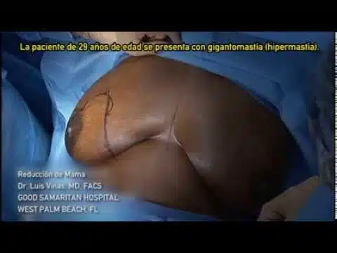 Reducción mamaria - Dispositivo Ultrasónico HARMONIC SYNERGY®
