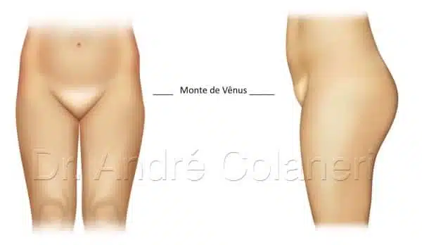 Cirugía del Monte Venus