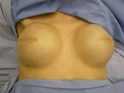 reconstruction mammaire