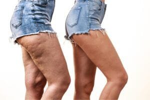 La liposuccion puede remodelar las piernas con edema