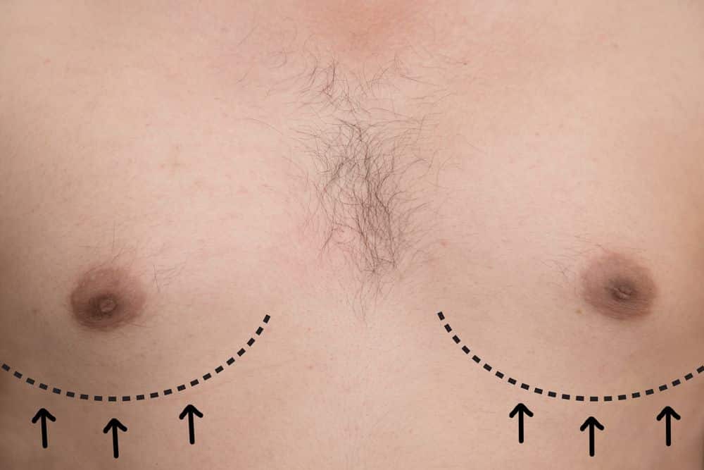 male breast surgery