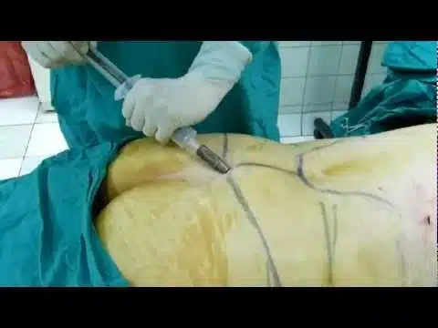 Trasplante de Grasa (HD) -Cirugía Corporal-Lima, Perú-Doctor Guanilo
