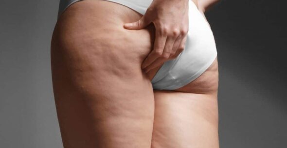 ¿La liposucción elimina la celulitis? Qué hace cada tratamiento y cuándo elegirlo 1 celulitis