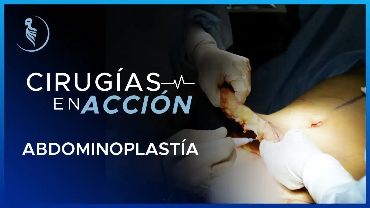 Cirugía Abdominal-Cirugía Plástica Martínez