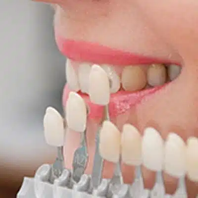 estética dental-Costo de la chapa en Dubai
