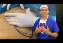 Cirugía plástica abdominal, esta es una cirugía para cambiar el cuerpo.