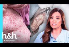 Sin censura: 3 cirugías de alto impacto | Dra. Sandra Lee: Experta en piel | Descubra la salud y el bienestar