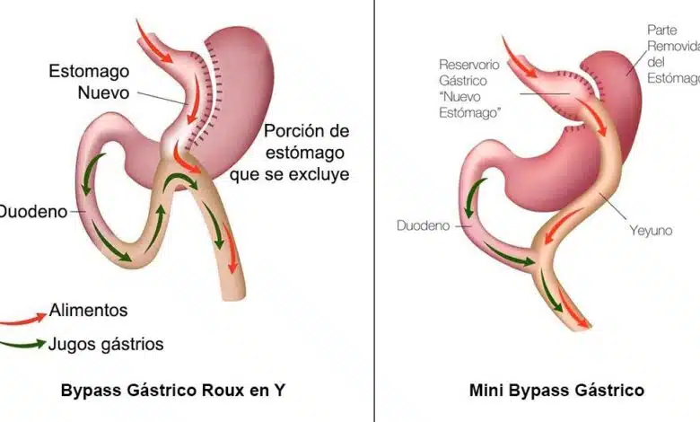 mini bypass gástrico-cirugiaestetica10