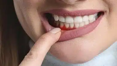 ¿Cuánto tiempo dura el tratamiento periodontal? ¿Cuánto tiempo dura el tratamiento periodontal?