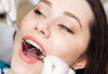 estética dental- ¿Cuál es el costo de los empastes dentales?
