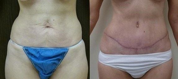 Abdominoplastia: mira antes de saltar 3 svg%3E