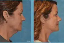 Foto de antes y después del lifting facial