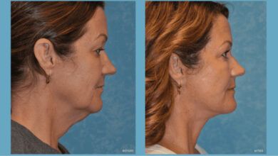 Foto de antes y después del lifting facial