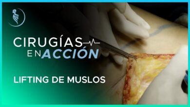 Lifting de Muslos - Cirugía Plástica Martínez