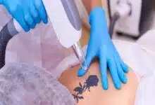 Tratamiento de eliminación de tatuajes permanentes