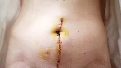 Cicatriz de histerectomia ¿Que aspecto tiene