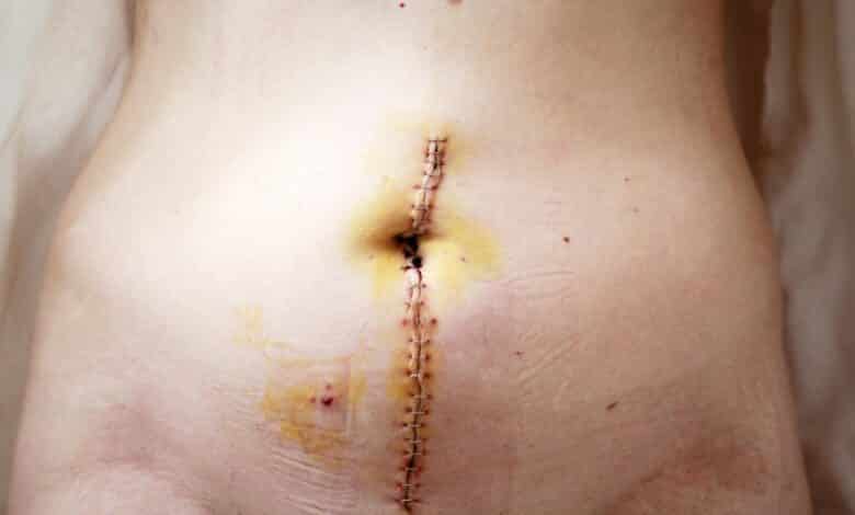 Cicatriz de histerectomia ¿Que aspecto tiene