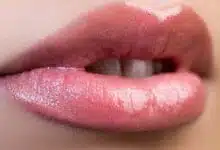 Levantamiento de labios y rellenos de labios