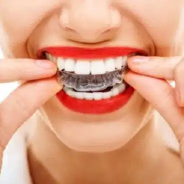 estética dental-costo de los retenedores dentales 