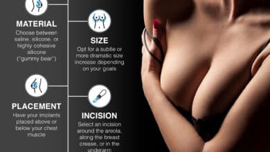 Cómo colocar sus implantes mamarios