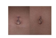 A small umbilical hernia (and belly button ring scar) before and after photos
