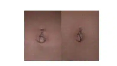 A small umbilical hernia (and belly button ring scar) before and after photos