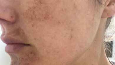 Treated skin 4 days after Intense Pulsed Light Treatment