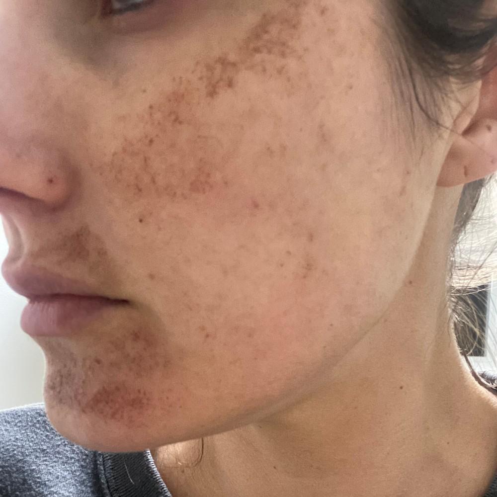 Piel tratada después de 4 días de terapia de luz pulsada intensa