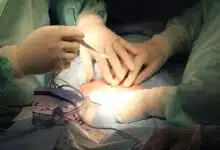 Método de incisión de aumento de senos: : s