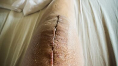 Drenaje de heridas quirúrgicas: qué es normal y qué no