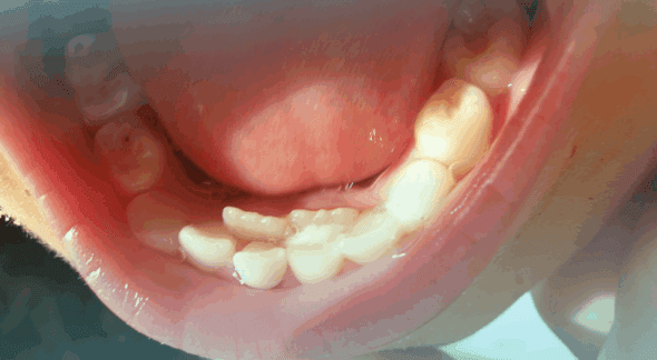 Dientes de tiburón lo que la naturaleza puede enseñarnos sobre salud dental