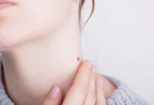 Remedios caseros para quitar verrugas: guía completa, segura y eficaz