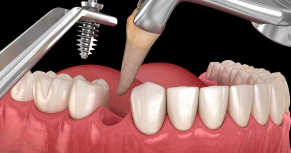 Implantes de Carga Inmediata quitar diente