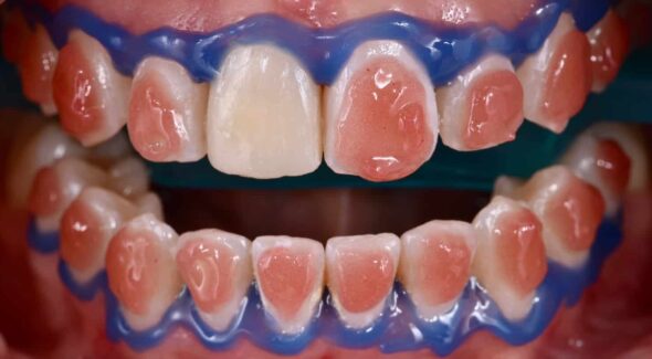 Blanqueamiento dental dientes clínica dental