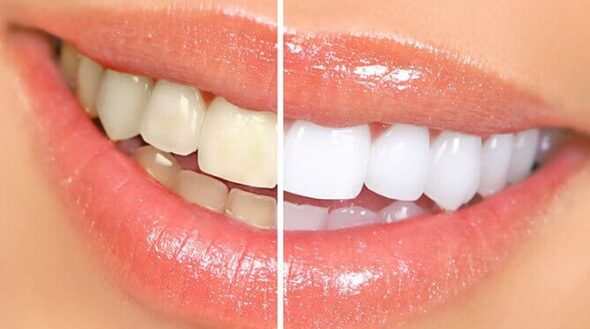 Blanqueamiento dental clínica dental