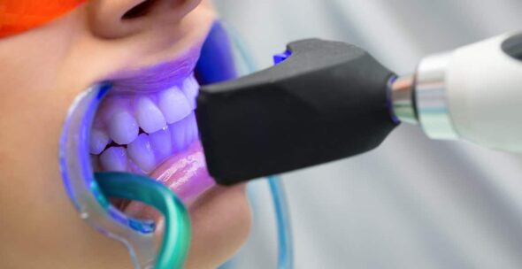 Blanqueamiento dental láser clínica dental