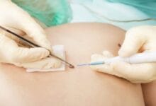 Cirugía de Mohs: precisión quirúrgica para tratar lesiones cutáneas